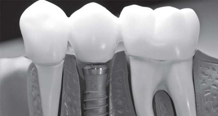 Application of 3D printing in dentistry